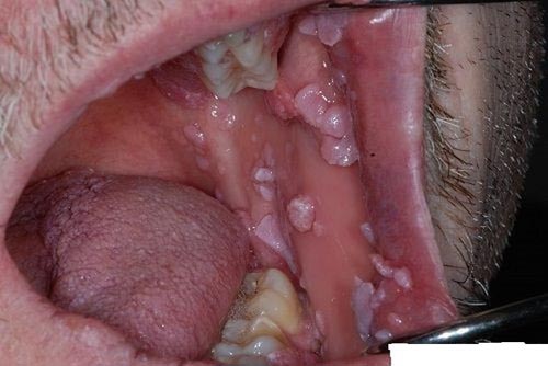 Hình ảnh bệnh sùi mào gà ở miệng
