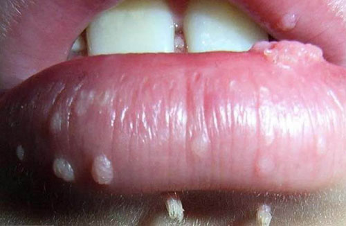 Hình ảnh bệnh sùi mào gà ở môi