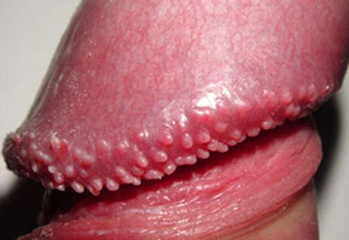 hình ảnh mụn gai sinh dục nam