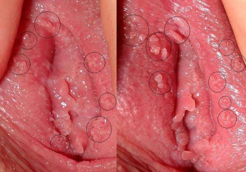 Hình ảnh mụn gai sinh dục nữ