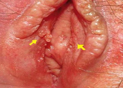 Hình ảnh mụn gai sinh dục nữ