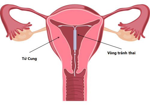 Đặt vòng tránh thai như thế nào