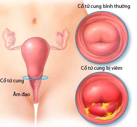 Viêm cổ tử cung là gì