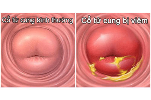Triệu chứng viêm cổ tử cung