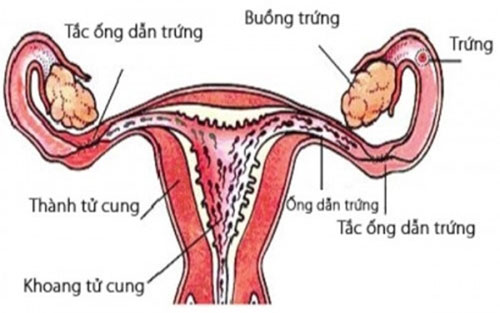Cách chữa tắc vòi trứng