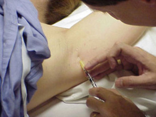 Điều trị hôi nách bằng tiêm Botox