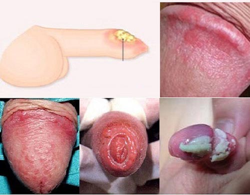 Hình ảnh viêm bao quy đầu ở trẻ em