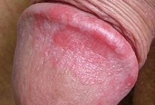 Hình ảnh bệnh viêm bao quy đầu