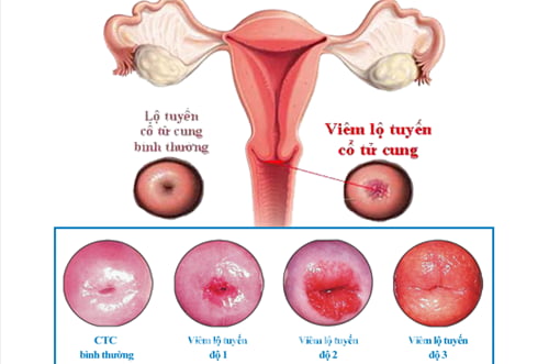 Viêm lộ tuyến cổ tử cung và những thông tin cần biết