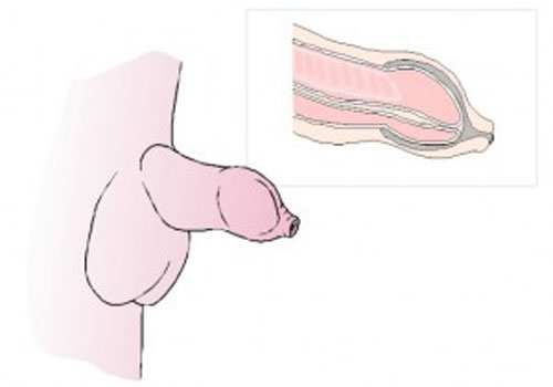 Bệnh hẹp bao quy đầu là gì?