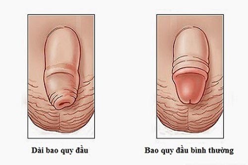 Thế nào là dài bao quy đầu?
