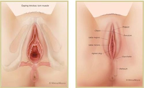 Thu nhỏ âm đạo là gì?