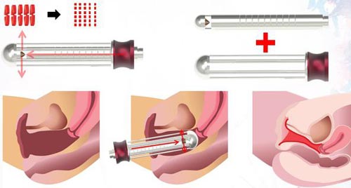Thu nhỏ vùng kín bằng laser