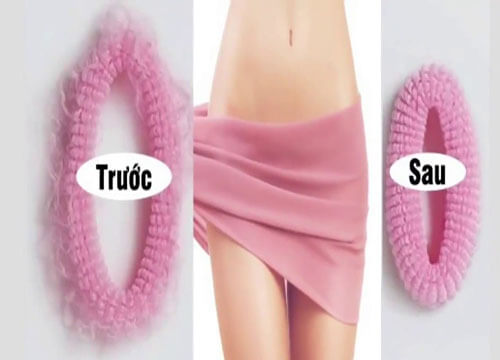 Chi phí thu nhỏ vùng kín bao nhiêu tiền?