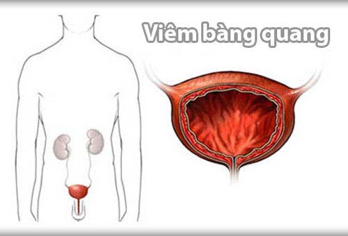 Bệnh viêm bàng quang