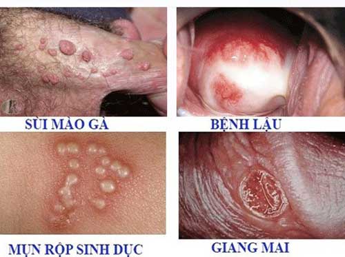Các bệnh xã hội thường gặp