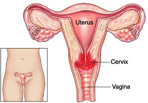 Viêm cổ tử cung là gì?