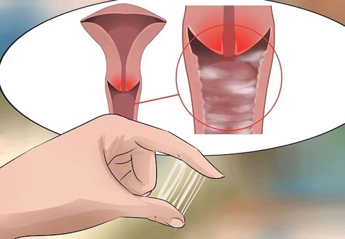 Triệu chứng viêm cổ tử cung
