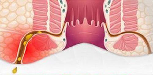 Các triệu chứng của bệnh rò hậu môn