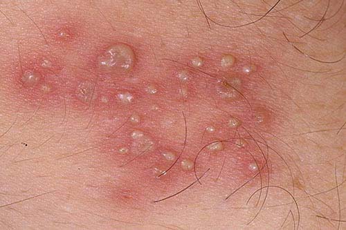 Dương vật bị nổi mụn nước là bệnh gì