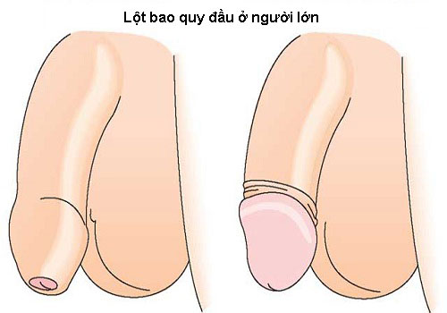 Cách lột bao quy đầu ở người lớn
