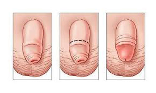 Bao nhiêu tuổi thì lột bao quy đầu được?