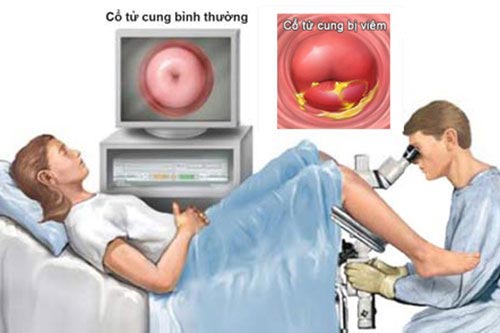 Cách điều trị viêm cổ tử cung