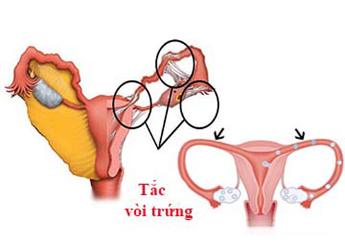 Tắc vòi trứng là gì