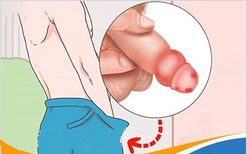 Bệnh viêm bao quy đầu là gì