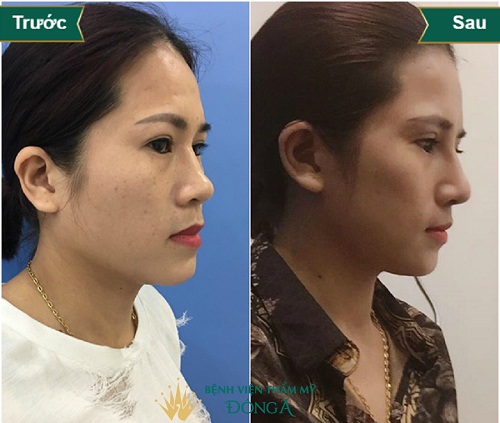 Sửa mũi phá tướng ? Làm Mũi Đẹp cả về Tướng Số lẫn Thẩm Mỹ - Hình 6