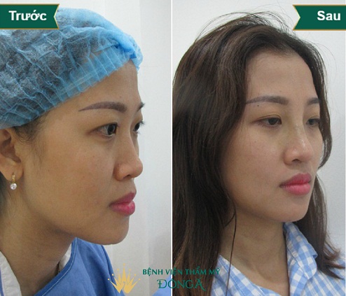 Sửa mũi phá tướng ? Làm Mũi Đẹp cả về Tướng Số lẫn Thẩm Mỹ - Hình 10