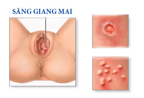 hình ảnh săng giang mai ở phụ nữ