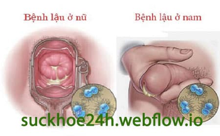 Triệu chứng bệnh lậu ở nam và nữ giới