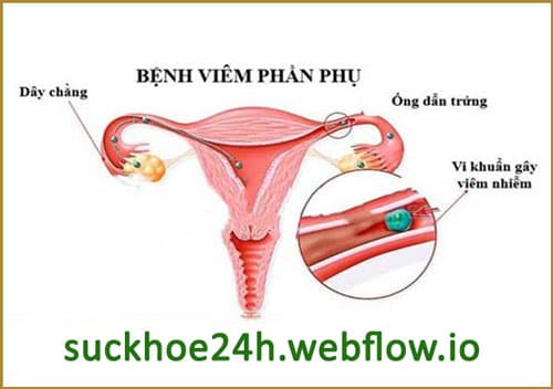 Tư vấn sức khỏe phụ nữ về viêm nhiễm phần phụ