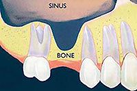 diagram of the sinus cavity filling empty space in jawbone
