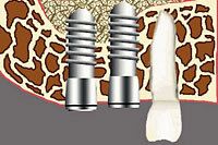 Graphic of two dental implants placed in jaw next to a natural tooth