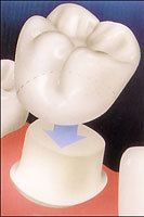 diagram of a crown placed over a prepared tooth
