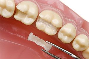 A dental inlay held with tweezers near a model of teeth
