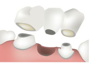 Cartoon of a dental bridge being placed on prepared teeth
