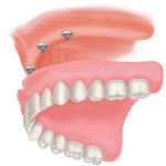 Snap-on dentures