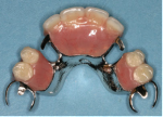 Partial dentures