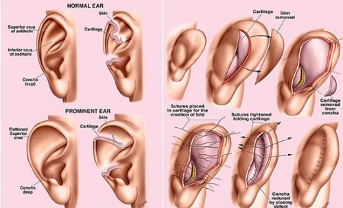 Sụn tai có mọc lại không