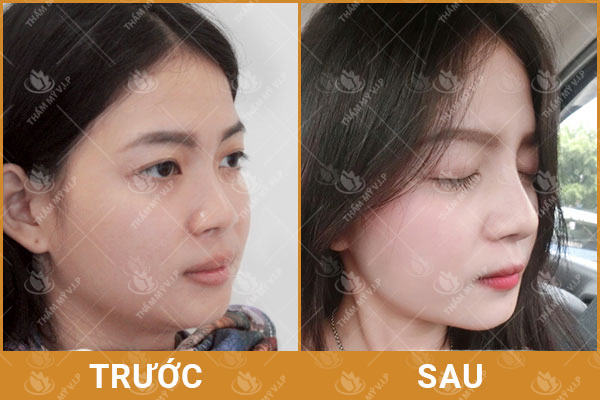 nâng mũi bọc sụn là gì