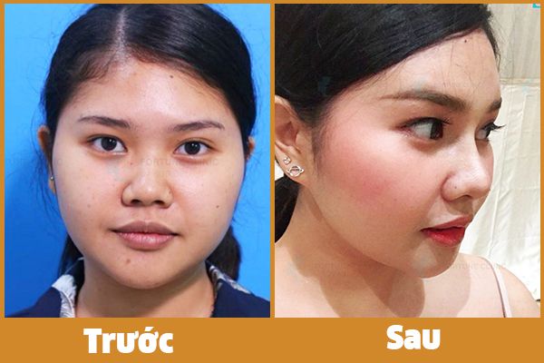 khách hàng nâng mũi s line bằng phương pháp nâng mũi không phẫu thuật