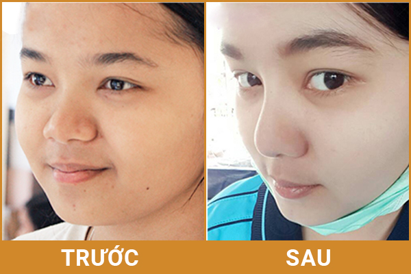 nâng mũi bằng sụn tự thân