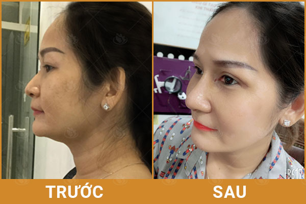 nâng mũi bằng sụn tự thân