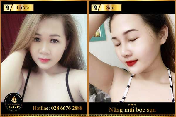 Có nên nâng mũi bằng sụn vành tai hay không