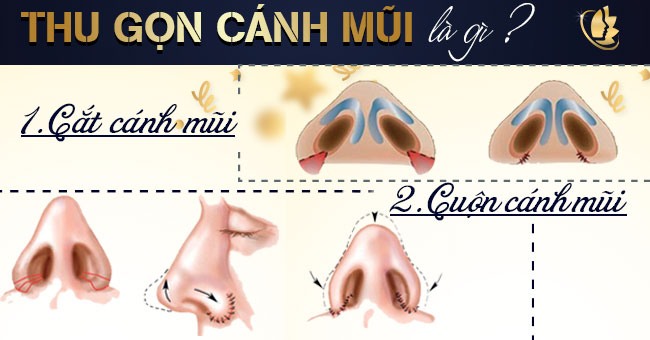 Thu gọn cánh mũi được bao lâu