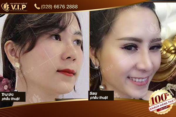 Tiêu chuẩn mũi đẹp