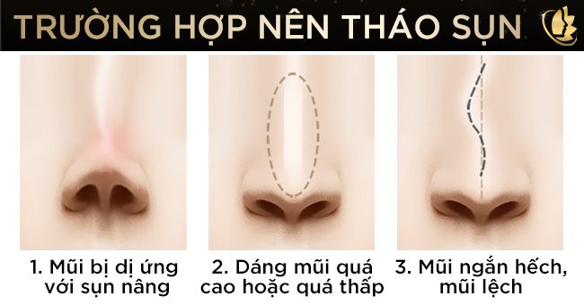 tháo sụn sau khi nâng mũi bao lâu thì lành